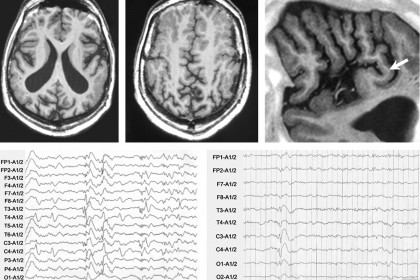 lennox-gastaut-syndrome