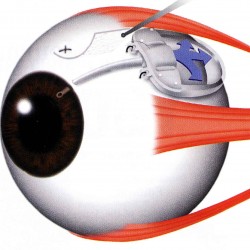 glaucoma treatment device