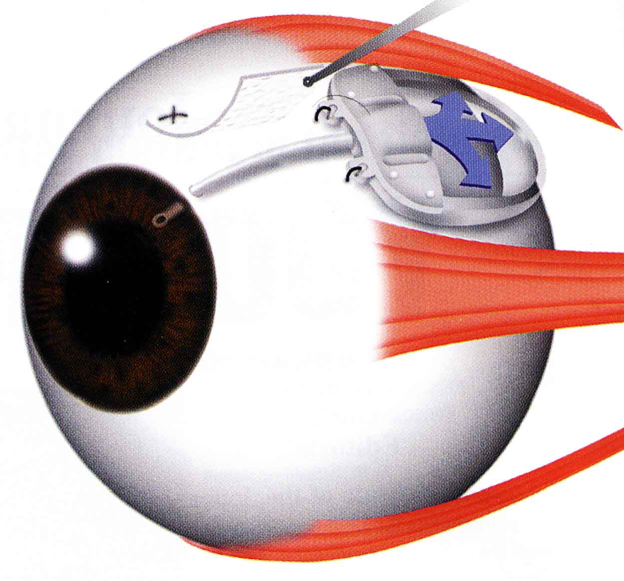 glaucoma treatment device